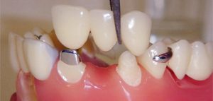 بریج یا پل دندانی چیست؟