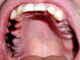 نخ بخیه و کاربرد آن در دندانپزشکی