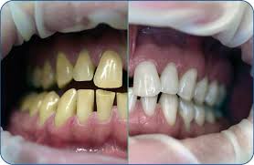 نکاتی در رابطه با هوم بلیچینگ دندان