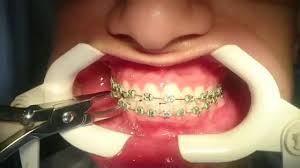 چرا از دندان قالب گیری می شود؟