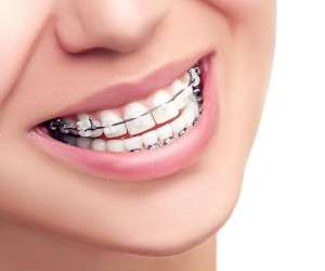 خلاصه ای از ارتودنسی دندان ها