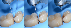 چگونه از ماتریکس بند در دندان پزشکی استفاده کنیم؟