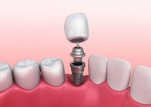 عوارض و عدم موفقیت ایمپلنت دندان
