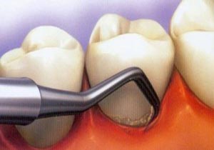 راه های جلوگیری از تشکیل شدن پلاک دندان