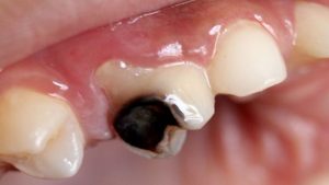 علت های پوسیدگی دندان چیست؟