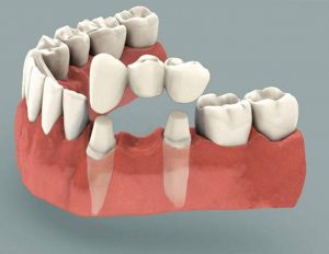مقایسه ایمپلنت دندان و بریج دندان