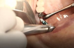 هیلینگ ایمپلنت دندان