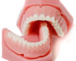 انواع قالب گیری در دندان پزشکی (2)