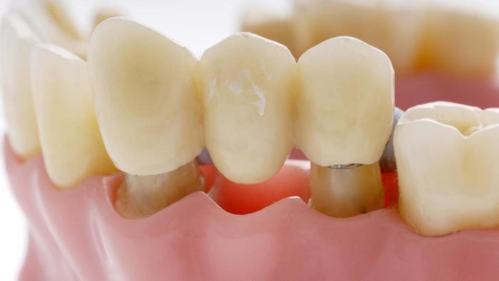 بریج یا پل دندانی چیست؟