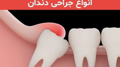 جراحی دندان و انواع جراحی
