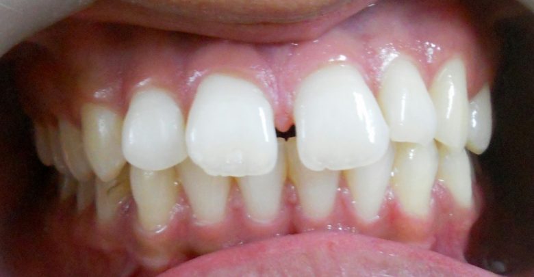 علت‌ها و دلایل وجود فاصله میان دندا‌ن‌ها