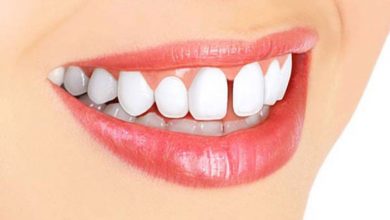 مشکلات مرتبط با فاصله میان دندان‌ها