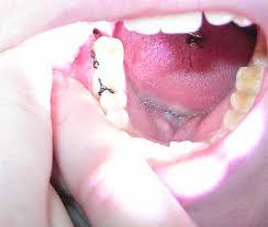 نخ بخیه و کاربرد آن در دندانپزشکی
