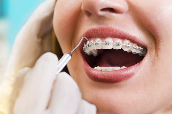 امکان انجام ارتودنسی با وجود پرکردگی دندان