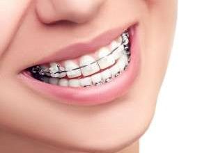 خلاصه ای از ارتودنسی دندان ها