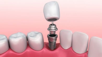 عوارض و عدم موفقیت ایمپلنت دندان