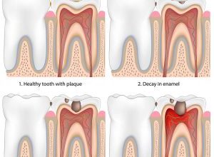 علائم پوسیدگی دندان و انواع آن