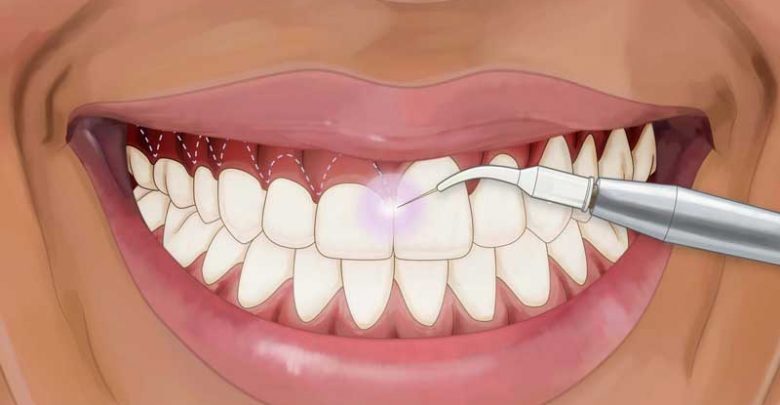 آشنایی با واژه های دندانپزشکی بخش چهار