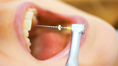 علائم پوسیدگی دندان و انواع آن
