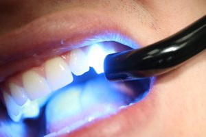 دستگاه لایت کیور دندانپزشکی با نور دیود 