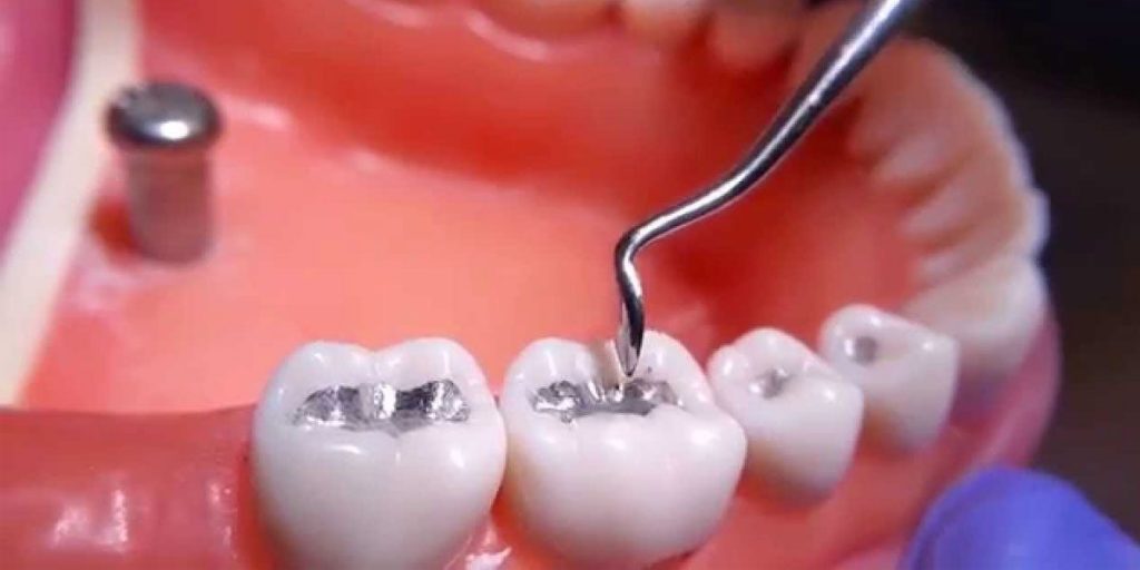 کاربرد جیوه در دندان پزشکی